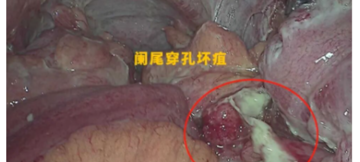 腹胀腹痛别当小毛病！56岁台商误诊后险遭脓毒血症，台心胃肠外科精准施救化险为夷