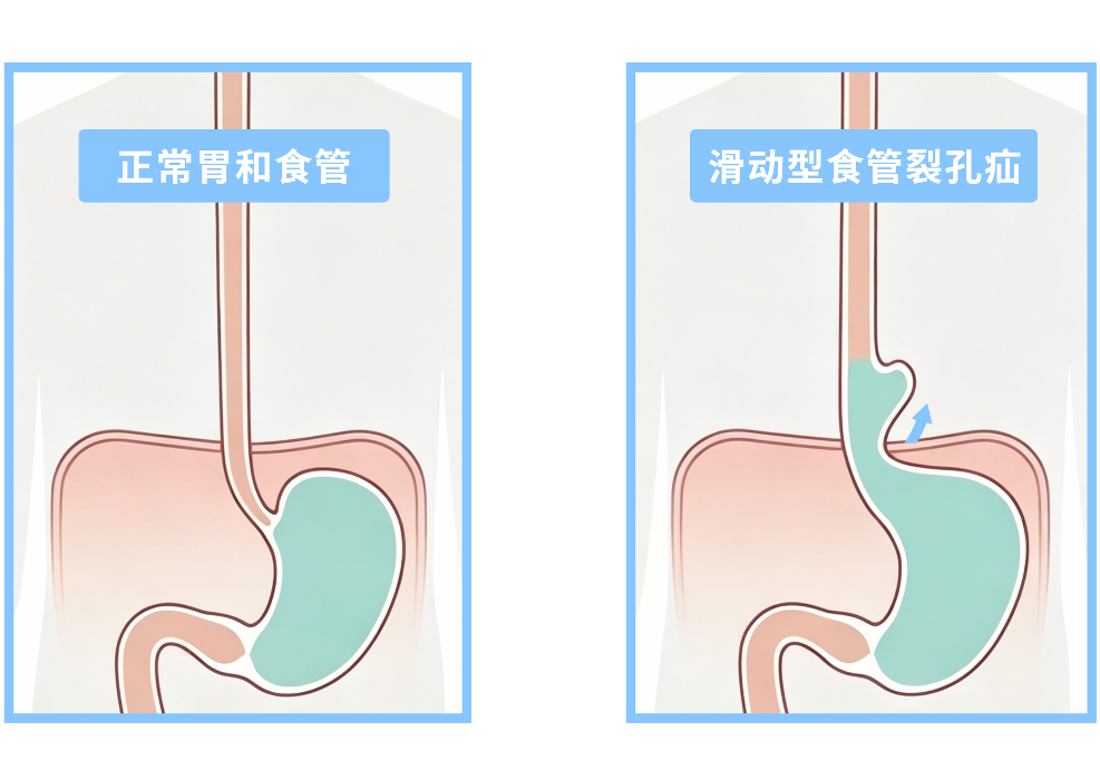 胸口总烧心？可能是“食管裂孔疝”在捣乱！