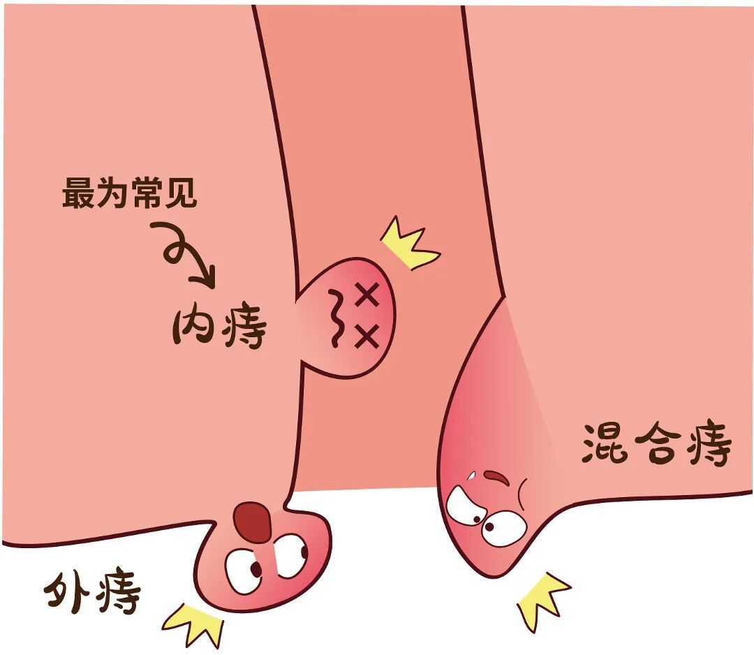 痔疮种类.jpg