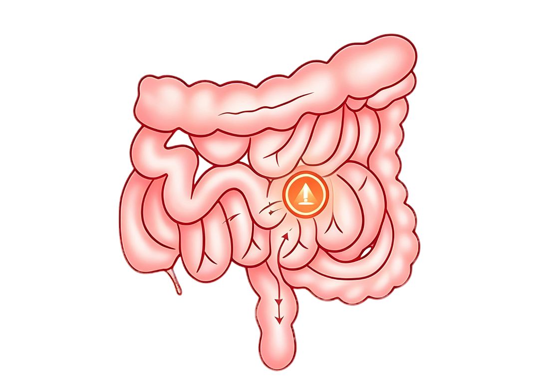 肠梗阻平面插画示意图生成 (1).png